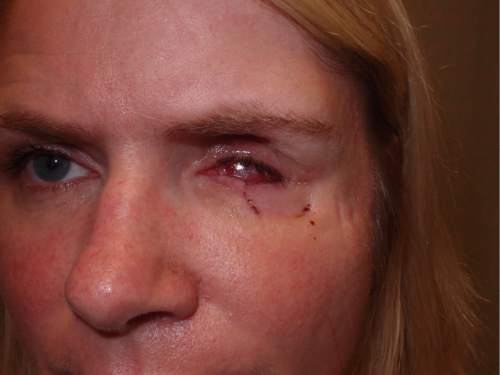 | Courtesy Attorney Robert Sykes 

Kristine Biggs Johnson shows the injuries to her eye that was a result of her being shot by a Morgan County Sheriff's deputy. The shooting was deemed unjustified by Davis County Attorney Troy Rawlings so Johnson and her attorney are filing a federal civil rights lawsuit against the deputy.