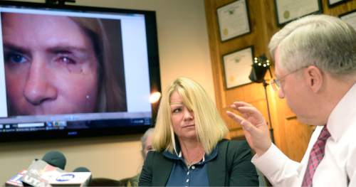 Al Hartmann  |  The Salt Lake Tribune
Attorney Bob Sykes, right, shows damage to his client Krisitne Biggs Johnson after she was shot in the eye in November 2012 by a Morgan County Sheriff's deputy. She is blind in that eye. This slide shows the eye after her first reconstruction surgery.  He is filing a federal civil rights lawsuit Thursday November 13 against a Morgan County Sheriff's deputy for improper use of deadly force.  The shooting was deemed unjustified by Davis County Attorney Troy Rawlings, but no charges were filed against the deputy.