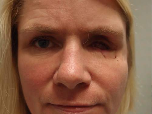 | Courtesy Attorney Robert Sykes 

Kristine Biggs Johnson shows the injuries to her eye that was a result of her being shot by a Morgan County Sheriff's deputy. The shooting was deemed unjustified by Davis County Attorney Troy Rawlings so Johnson and her attorney are filing a federal civil rights lawsuit against the deputy.