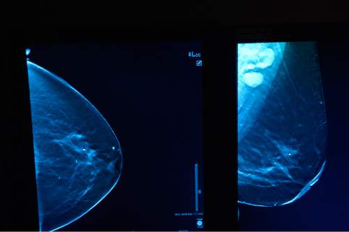 Leah Hogsten  |  The Salt Lake Tribune
3D imaging at The Breast Care Center at Intermountain Medical Center in Murray shows a woman's breast with cancer with enlarged lymph nodes. According to the revised guidelines set forth by the U.S. Preventive Services Task Force, the timing and spacing of medical exams for women has changed, affecting mammograms and pap smears, Friday, May 1, 2015.