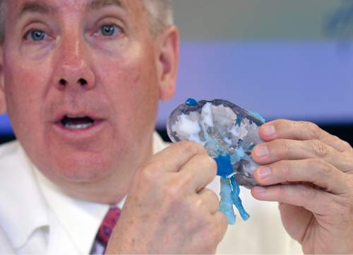 Al Hartmann  |  The Salt Lake Tribune Al Hartmann  |  The Salt Lake Tribune 
 Jay Bishhoff, MD, Intermountain Urological Institute Director holds a 3D printed kidney model at press conference at Intermountain Medical Center in Murray Monday June 20.  He explained how staff at Intermountain Medical Center printed and used a 3D model of  Linda Green's kidney to help them preserve the organ during a complicated tumor-removal procedural.
The 3D-printed model allowed doctors to study the patient's kidney in 3D to determine how to best remove the tumor as it was located in a precarious location adjacent to the artery, vein and ureter.  
Thanks to the 3D-printed model of the organ, doctors were able to successfully remove the tumor and save the patient's kidney.