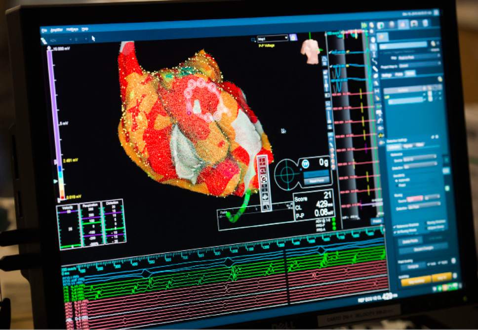 Steve Griffin / The Salt Lake Tribune


A real-time 3D image of a patient's  heart is viewed  on a screen as Intermountain Medical Center Heart Institute electrophysiologist John Day, MD, left, performs the nation's first case using new heart-mapping technology for the treatment of abnormal heart rhythms at the Intermountain Medical Center Heart Institute in in Murray Monday December 19, 2016.  During the procedure, the Intermountain Medical Center team, used St. Jude Medical's EnSite PrecisionTM cardiac mapping system to create 3-D images of the heart.