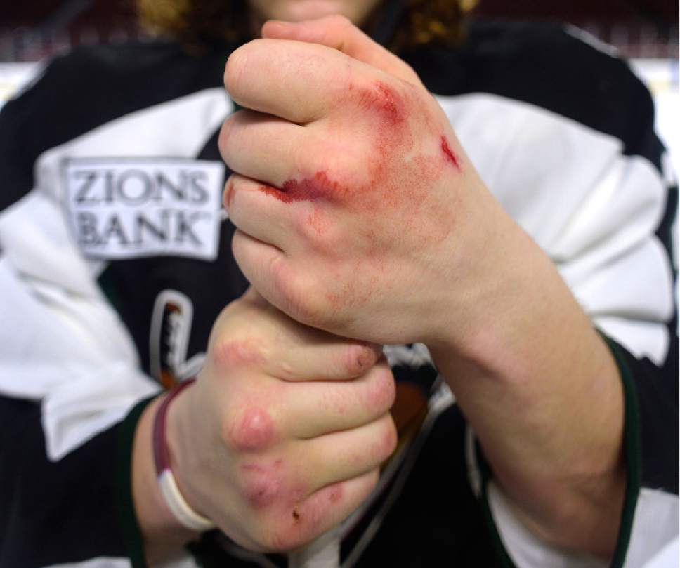 Scott Sommerdorf | The Salt Lake Tribune
Utah Grizzlies hockey player Travis Howe poses for a portrait with his knuckles bleeding after practice, Thursday, March 2, 2017.